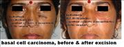 Before After Pictures,Delhi,skin cancer  bcc